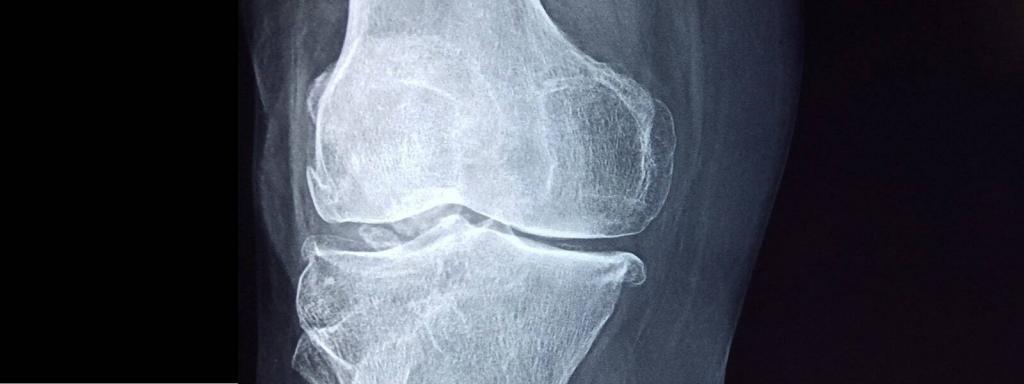 Can I make bone tissue separate from the human body? Kazakh scientists have launched a unique project to answer this question. A group of scientists from NU, led by Professor Dana Akylbekova, developed a new technology that allows you to grow human bones and print their 3D model.