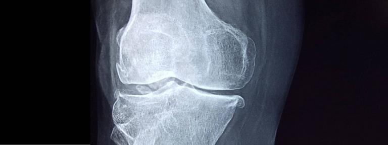 Can I make bone tissue separate from the human body? Kazakh scientists have launched a unique project to answer this question. A group of scientists from NU, led by Professor Dana Akylbekova, developed a new technology that allows you to grow human bones and print their 3D model.